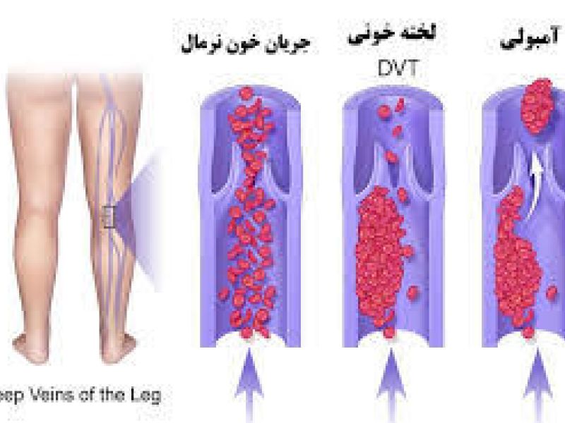 مشمولانی که مبتلا به ترومبوآمبولی ریه باشند از خدمت سربازی معاف می شوند