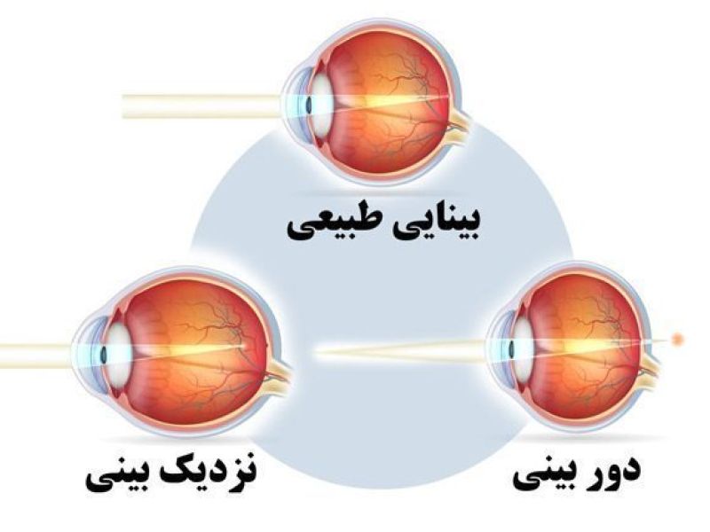 مشمولان مبتلا به دوربینی از سربازی معاف می شوند