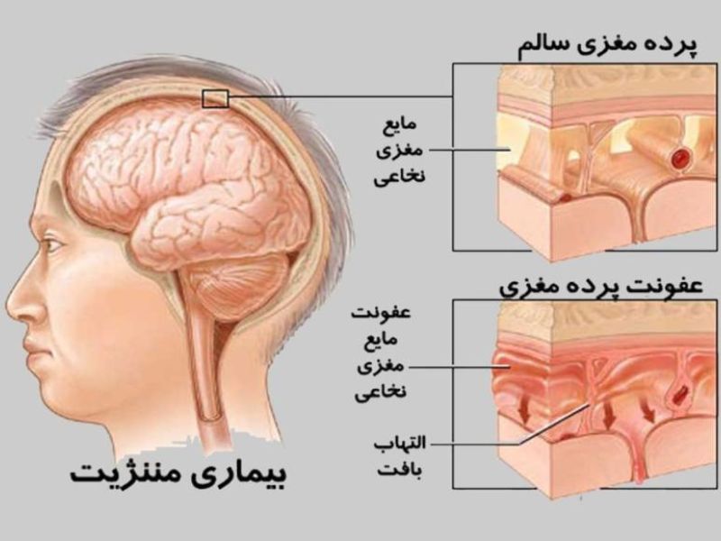 مشمولان مبتلا به انواع خونریزی سربر و مننژ از سربازی معاف می شوند