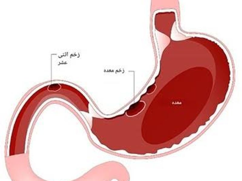 مشمولان مبتلا به زخم دستگاه گوارش از سربازی معاف می شوند