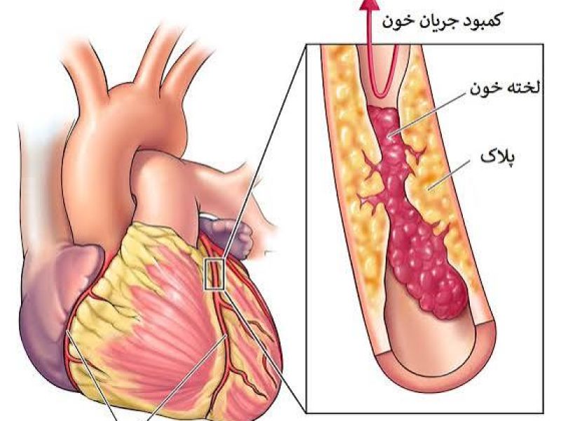 مشمولانی که به  بيماري عروق كرونر  مبتلا باشند از خدمت سربازی معاف می شوند