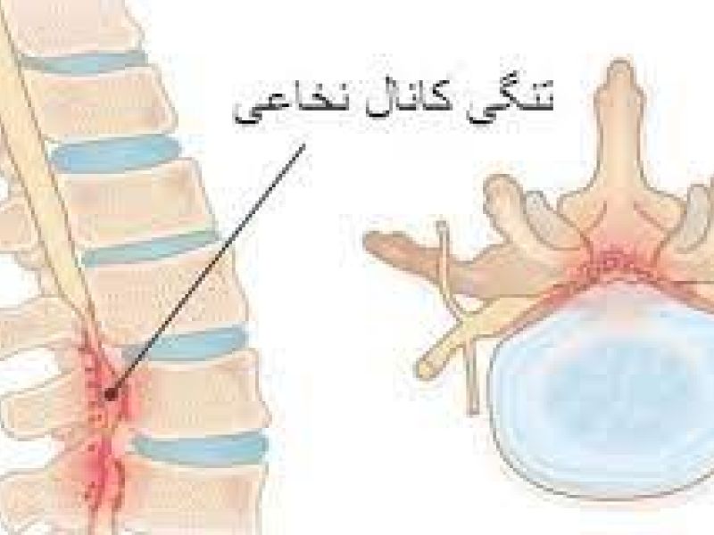 مشمولان مبتلا به کمپرسیونهای نخاعی به هر علت ، از سربازی معاف می شوند.