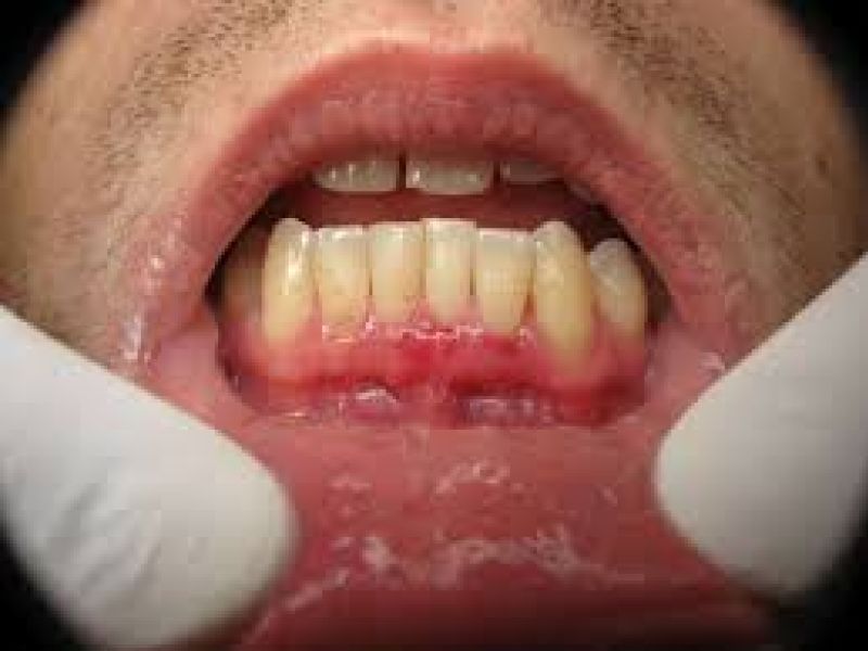 مشمولان مبتلا به تومورهاي خوش خيم فک از خدمت سربازی معاف می شوند.