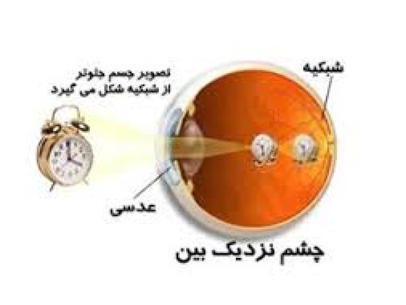 مشمولان مبتلا به نزدیک بینی از سربازی معاف می شوند