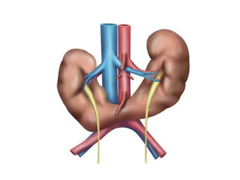مشمولان مبتلا به کلیه نعل اسبی و کلیه اکتوپیک از خدمت سربازی معاف می شوند