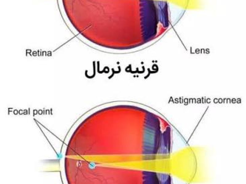 شرایط معافیت پزشکی آستیگماتیسم چشم برای مشمولان خدمت سربازی