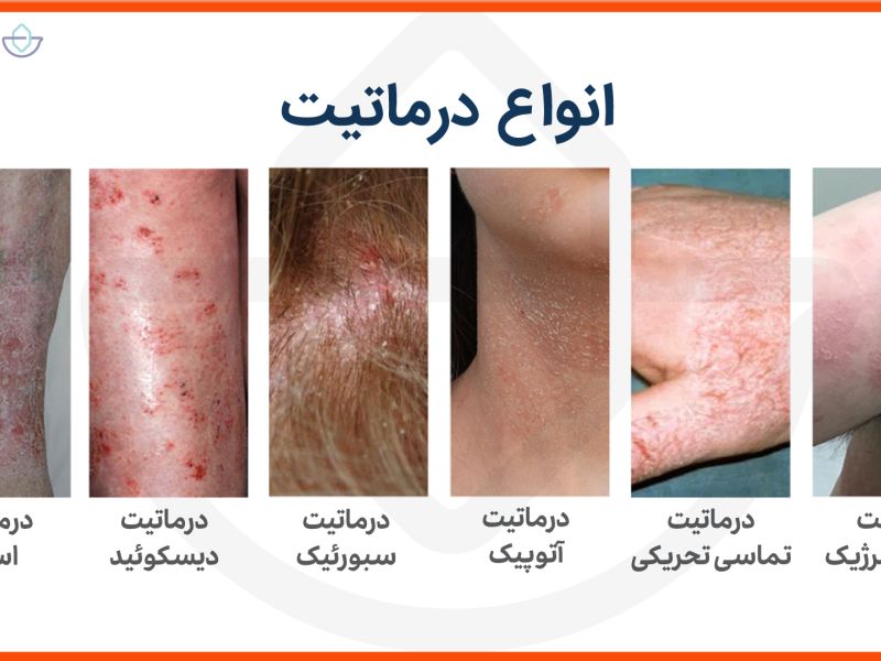 مشمولان مبتلا به درماتوزهای اتو ایمیون از سربازی معاف می شوند