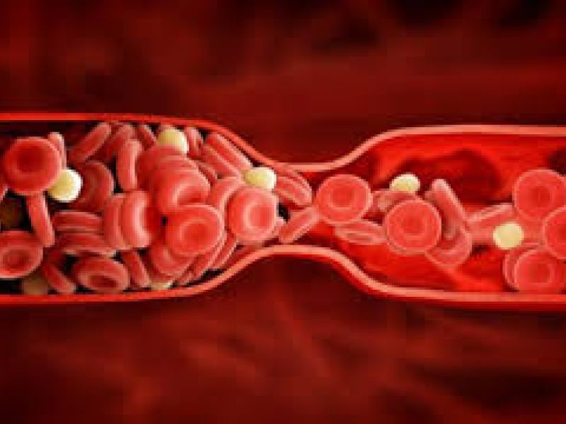 مشمولان مبتلا به پلی گلبولی اوّليه (پلی سيتمی اوليه ) و ترومبوسيتوز اوليه از خدمت سربازی معاف می شوند