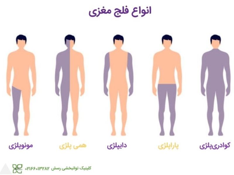 مشمولان مبتلا به انواع فلج و ضعف عضلانی از سربازی معاف می شوند