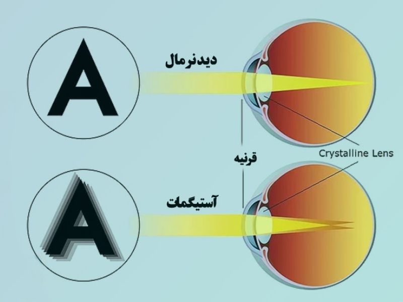 مشمولان مبتلا با آستیگماتیسم از سربازی معاف می شوند