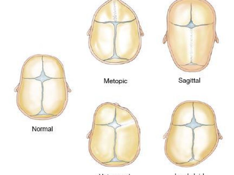 تغییر شکل مادرزادی جمجمه می تواند منجر به معافیت پزشکی مشمولین شود