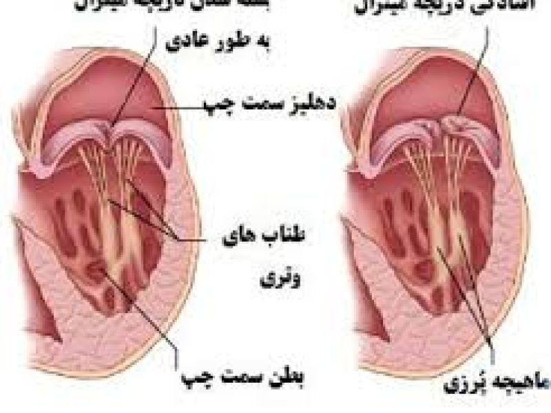 مشمولانی که دارای عوارض عضوی دریچه قلب باشند از سربازی معاف می شوند