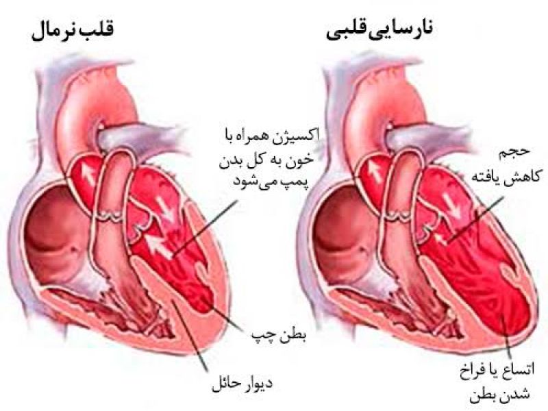 مشمولانی که به نارسایی مزمن قلب مبتلا باشند از خدمت سربازی معاف می شوند