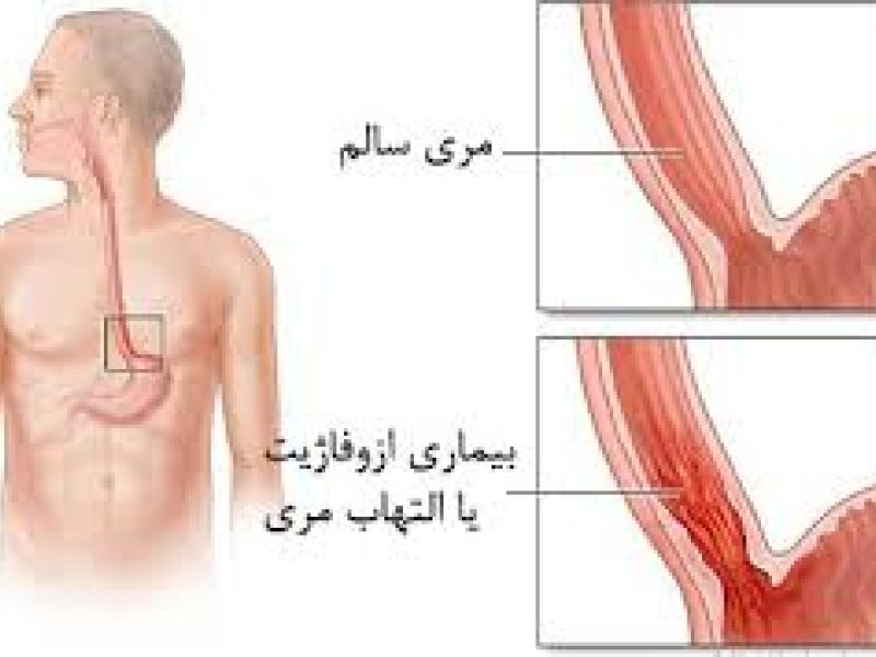 مشمولان مبتلا به ازوفاژیت از سربازی معاف می شوند