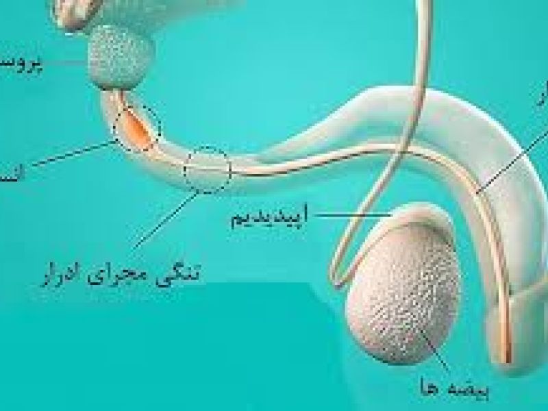 مشمولان مبتلا به انسداد ادراری از سربازی معاف می شوند