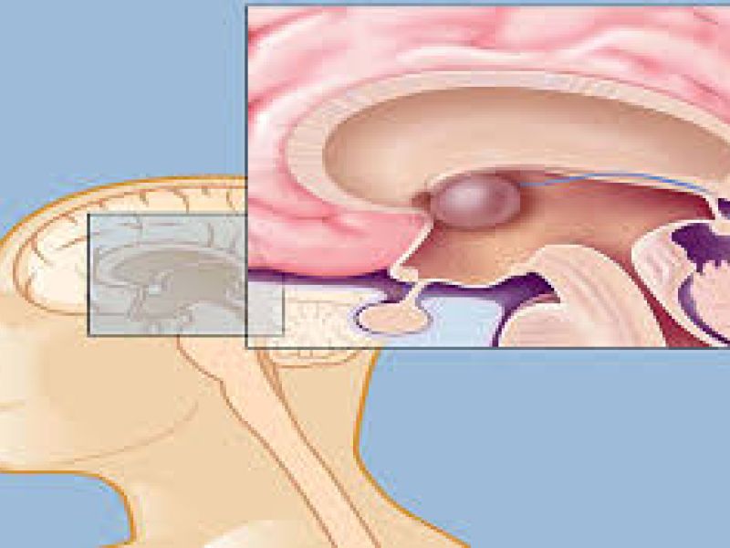 مشمولانی که به کیست هاس آراکنوئید مبتلا باشند از سربازی معاف می شوند