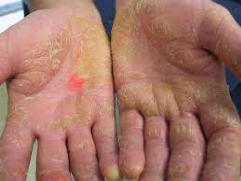 مشمولان مبتلا به هیپودرمیت های ندولر از سربازی معاف می شوند