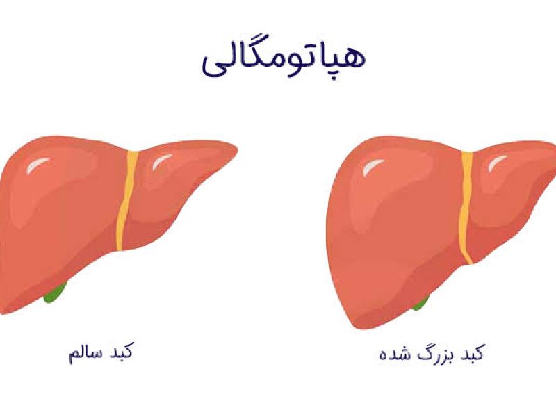 مشمولان مبتلا به هپاتومگالی از خدمت سربازی معاف می شوند