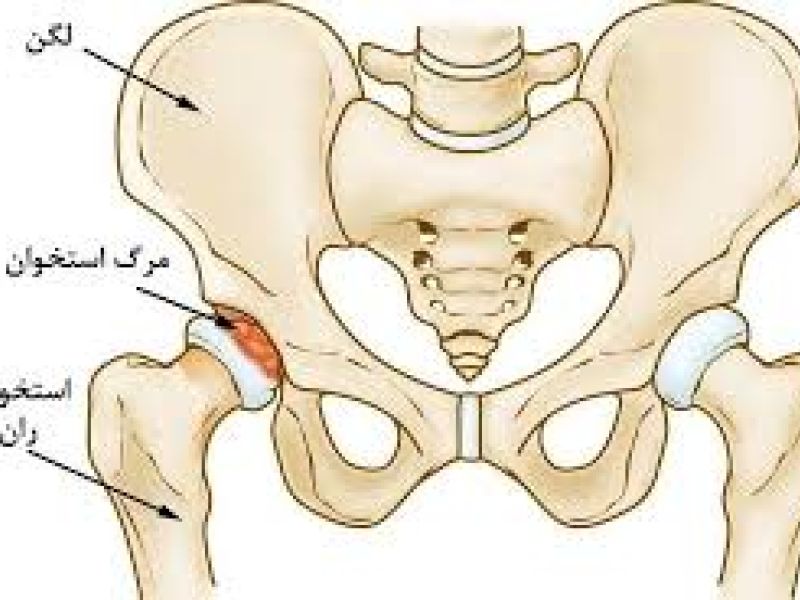 مشمولانی که به هر علت به نكروز آواسكولار سراستخوان ران مبتلا باشند از خدمت سربازی معاف می شوند.