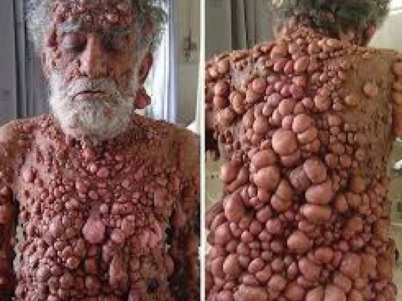 مشمولان دارای بیماری نورو فیبروماتوز از سربازی معاف می شوند.