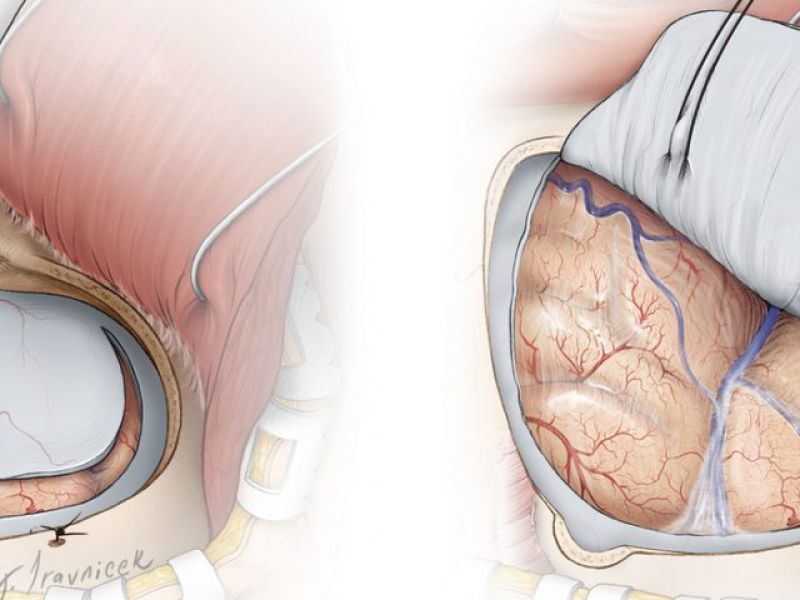 مشمولانی که سابقه عمل جراحی روی مغز و جمجمه داشته باشند از سربازی معاف می شوند.