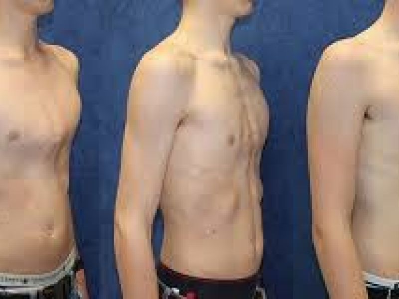 تغییر شکل مادرزادی قفسه صدری مشمولان سبب معافیت آنان می شود