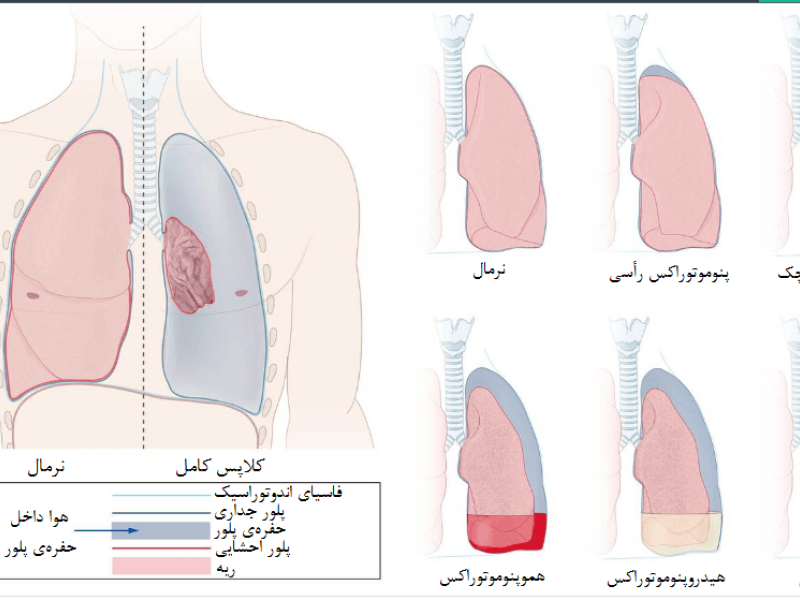 مشمولان مبتلا به پنوموتوراکس خودبخودی ریه از سربازی معاف می شوند